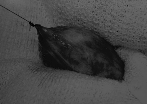 8张图带你解锁新技能——膀胱切开术（附手术视频）