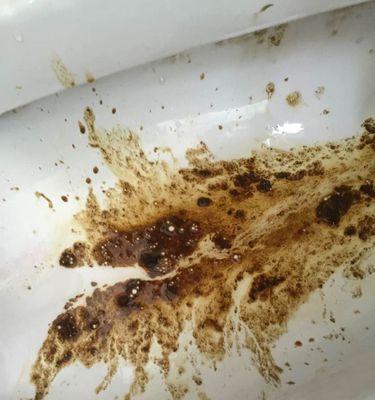 白色浆糊状的大便是什么原因引起的？（解析白色浆糊状大便的病因与治疗方法）