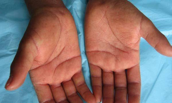 探索英斗皮肤病的原因和治疗方法（了解英斗皮肤病的类型和症状，找到有效的治疗方法）