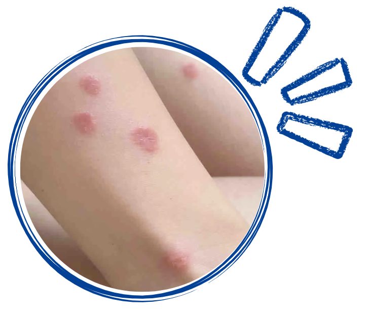 猫癣会传染人吗